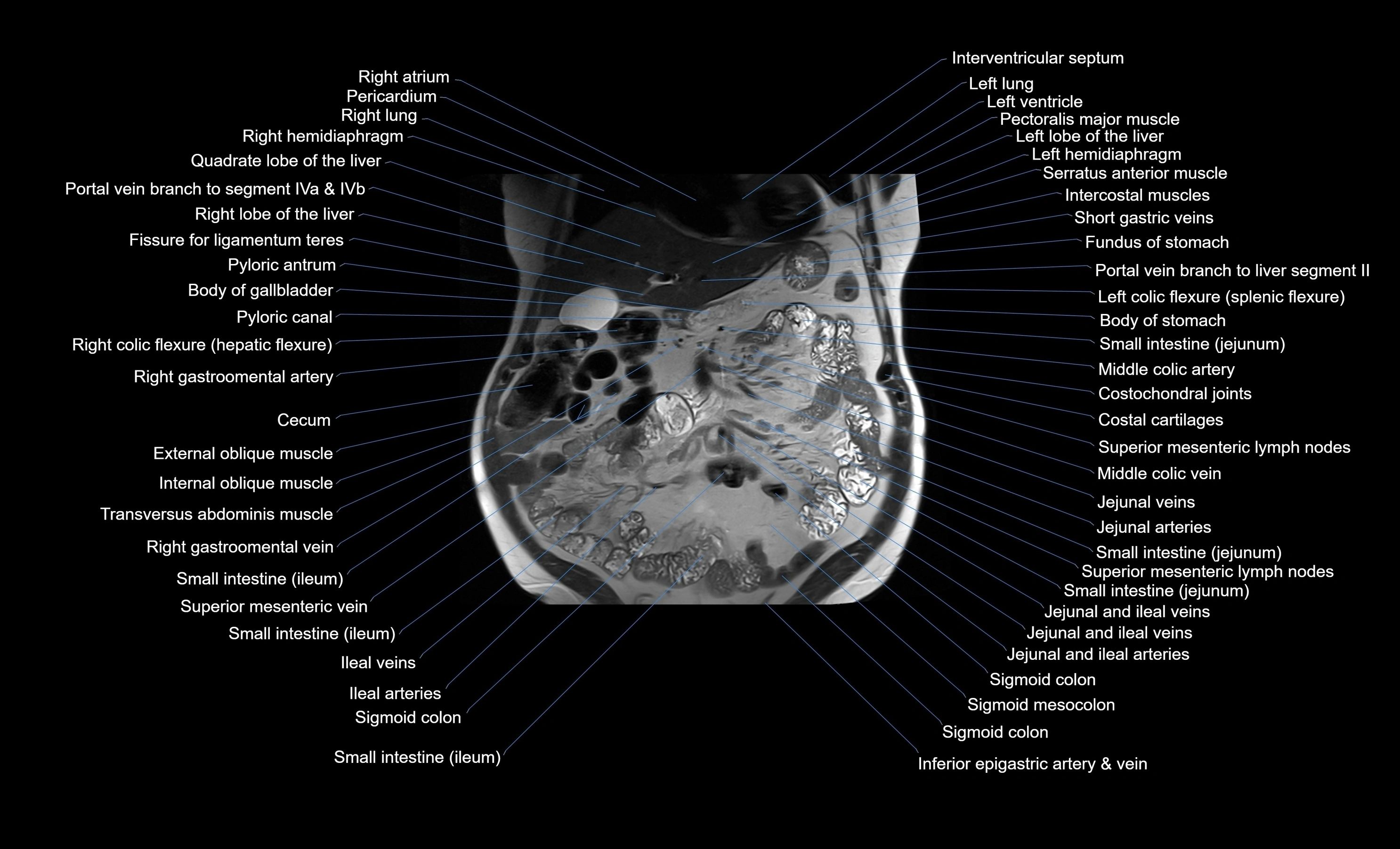 MRI Abdomen coronal labelled cross sectional anatomy radiology  image-img-00001-00021.webp